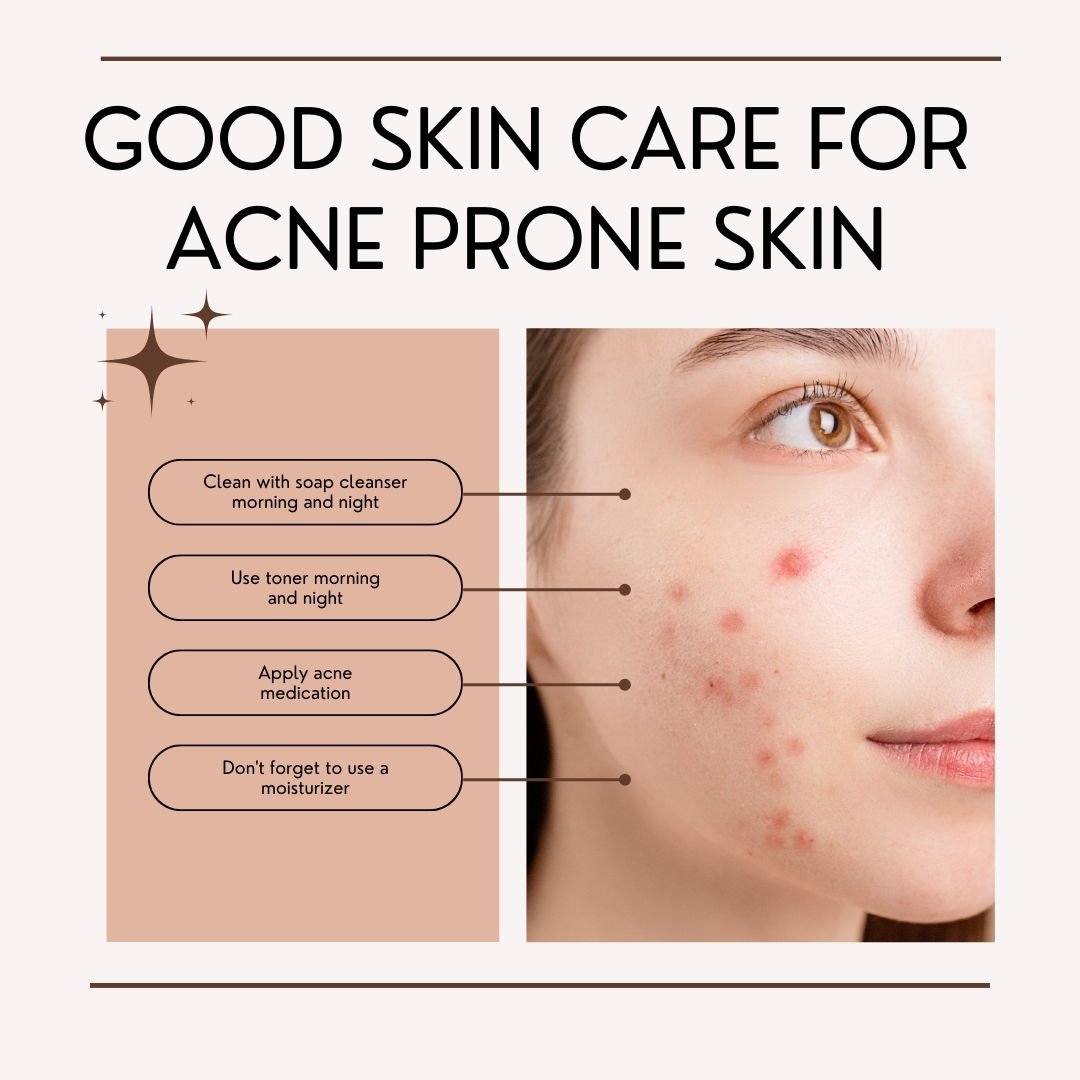 PCOS Acne Blog Image - Nurturing Acne-Prone Skin with insights from Dr. Shabnam Sharjil at PCOS Ferticure Clinic for effective and personalized PCOS-PCOD management.